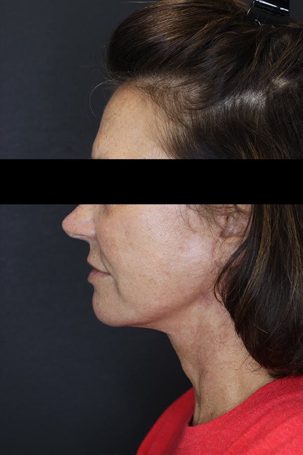 Facelift & Necklift Before & After Gallery - Patient 53083078 - Image 6