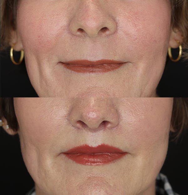 Lip Lift Before & After Gallery - Patient 53083551 - Image 1