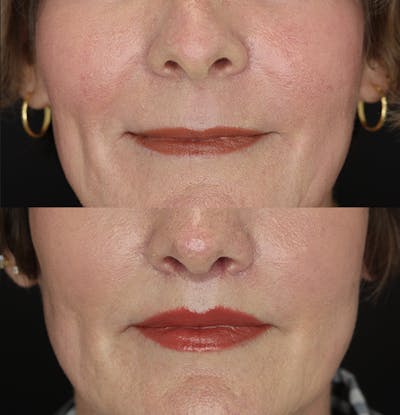 Lip Lift Before & After Gallery - Patient 53083551 - Image 1