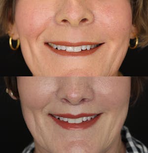 Before and after lip lift