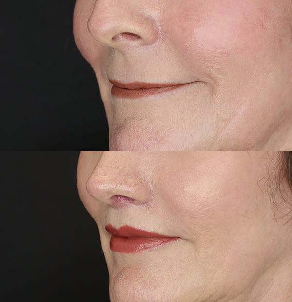Lip Lift Before & After Gallery - Patient 53083551 - Image 3