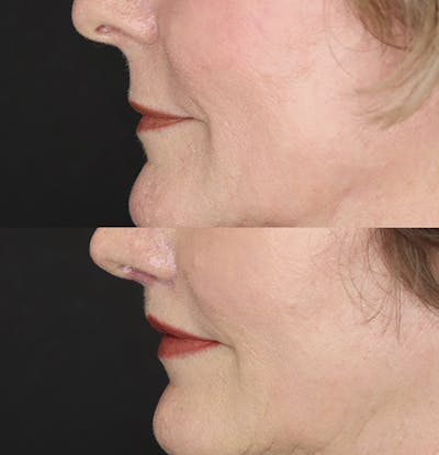 Lip Lift Before & After Gallery - Patient 53083551 - Image 4