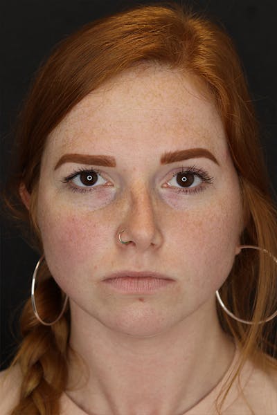 Rhinoplasty Before & After Gallery - Patient 53084379 - Image 1