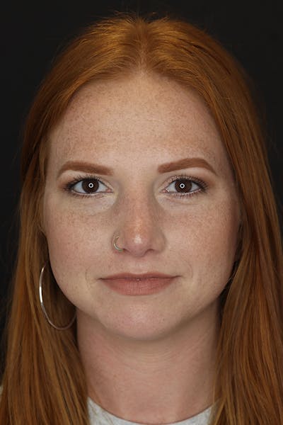 Rhinoplasty Before & After Gallery - Patient 53084379 - Image 2