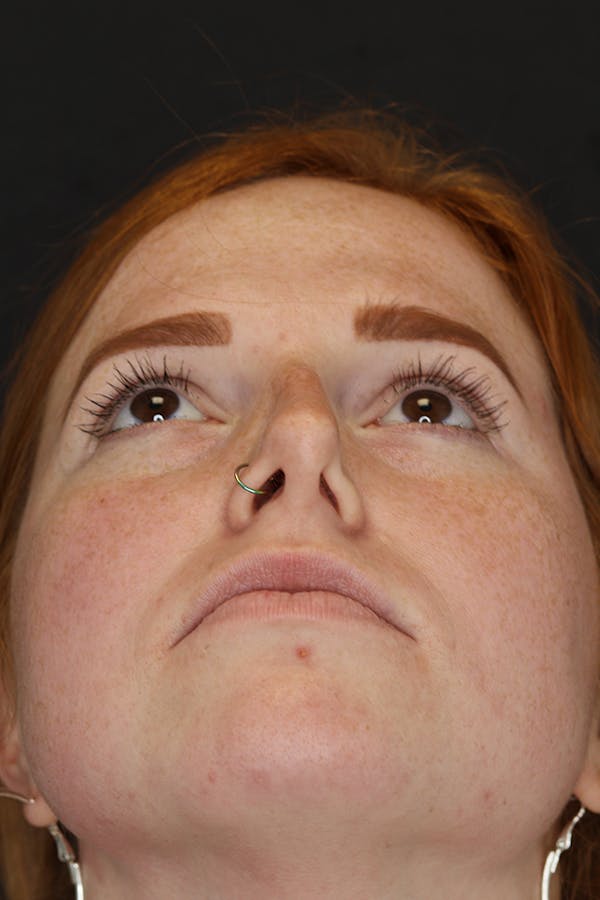 Rhinoplasty Before & After Gallery - Patient 53084379 - Image 3