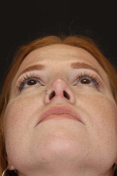 Rhinoplasty Before & After Gallery - Patient 53084379 - Image 4