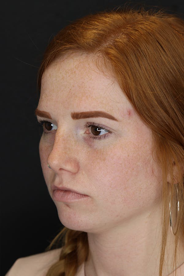 Rhinoplasty Before & After Gallery - Patient 53084379 - Image 5
