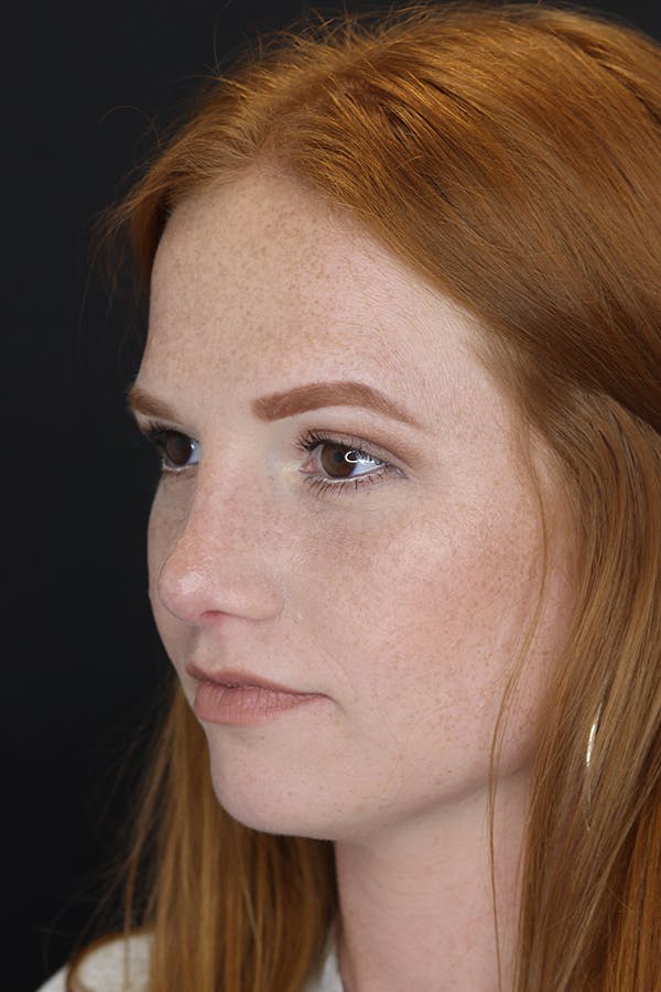 Rhinoplasty Before & After Gallery - Patient 53084379 - Image 6