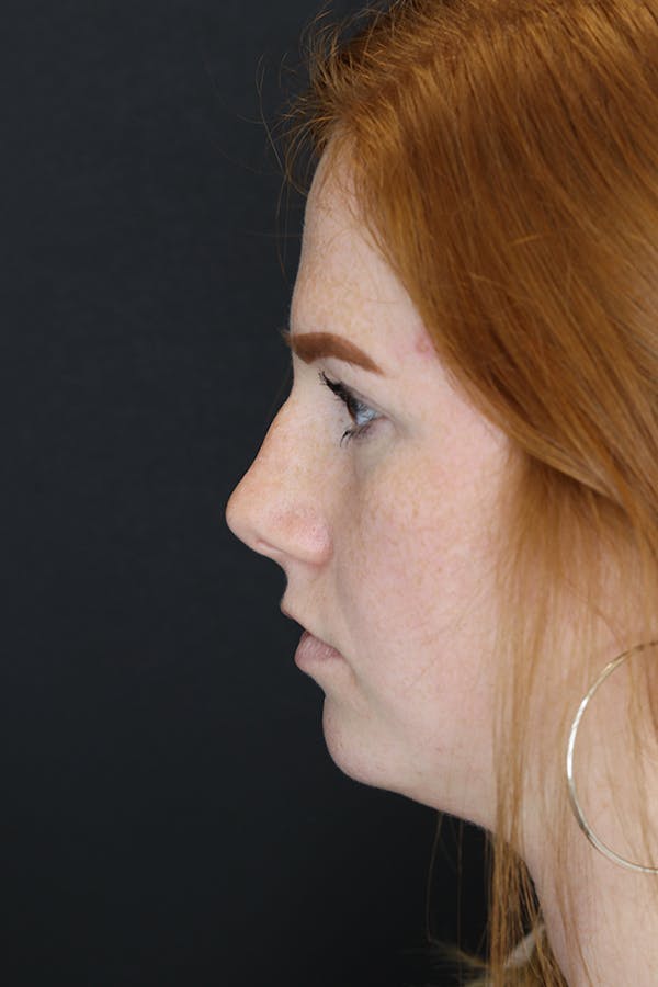 Rhinoplasty Before & After Gallery - Patient 53084379 - Image 7