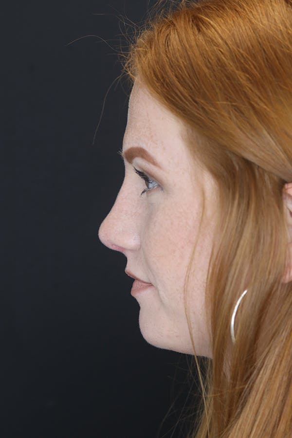 Rhinoplasty Before & After Gallery - Patient 53084379 - Image 8