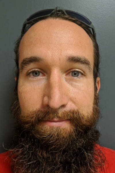 Rhinoplasty Before & After Gallery - Patient 53084381 - Image 1