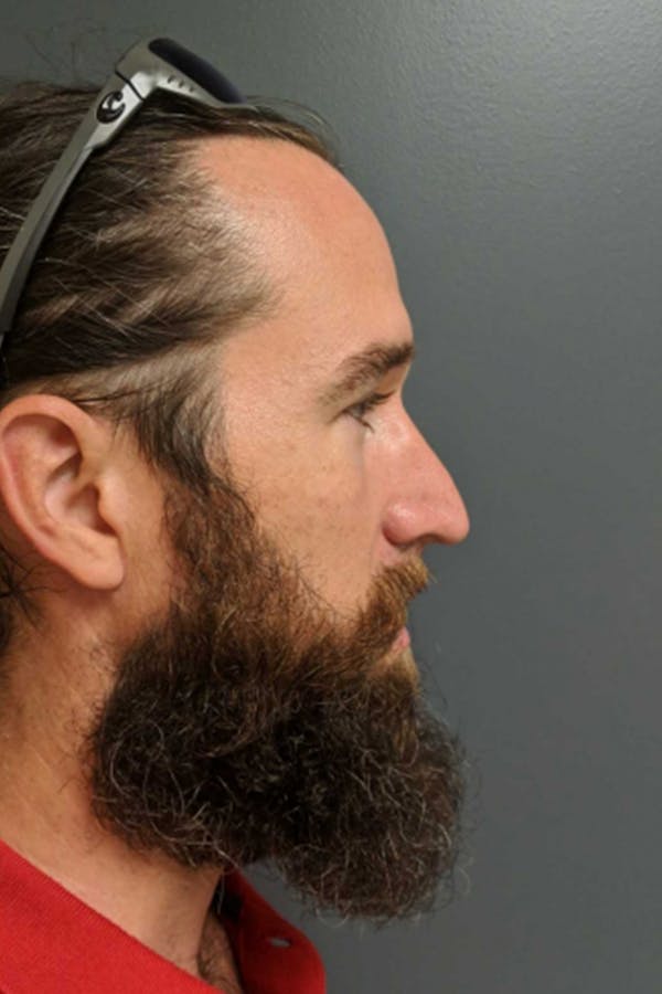 Rhinoplasty Before & After Gallery - Patient 53084381 - Image 5