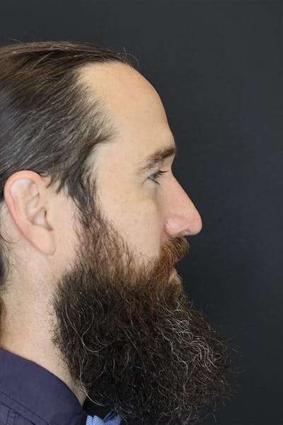 Rhinoplasty Before & After Gallery - Patient 53084381 - Image 6