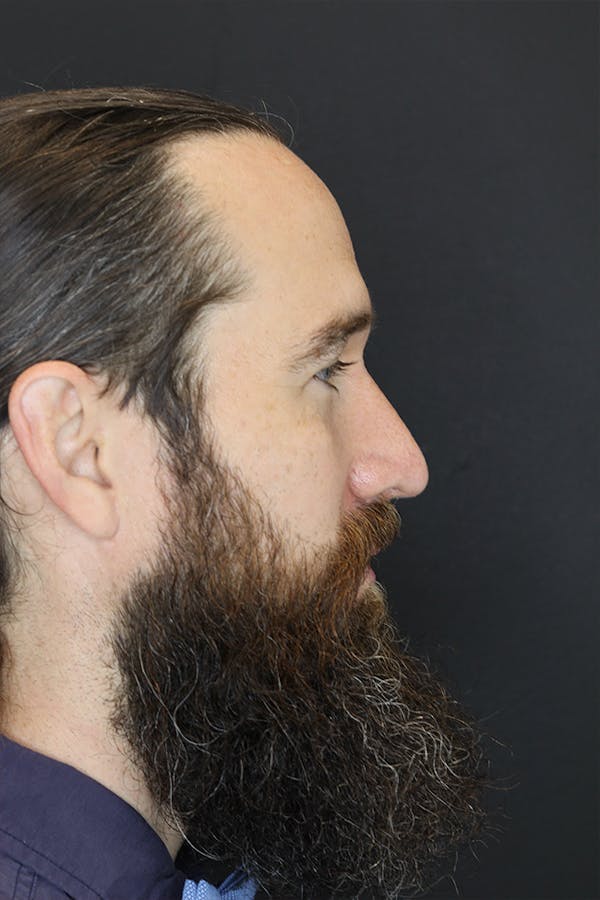 Rhinoplasty Before & After Gallery - Patient 53084381 - Image 6