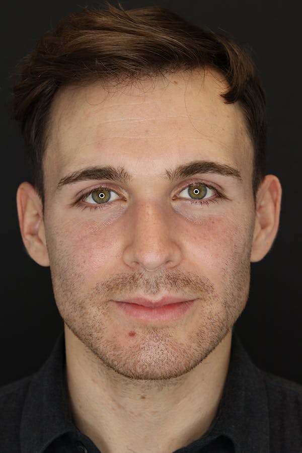 Rhinoplasty Before & After Gallery - Patient 53084383 - Image 1