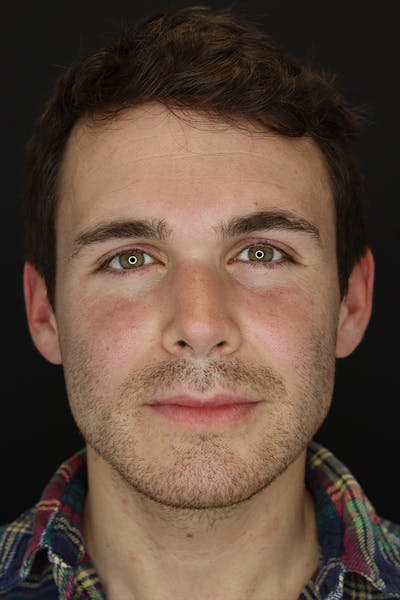 Rhinoplasty Before & After Gallery - Patient 53084383 - Image 2