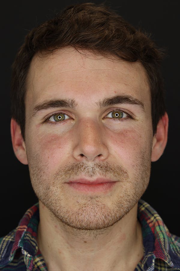 Rhinoplasty Before & After Gallery - Patient 53084383 - Image 2