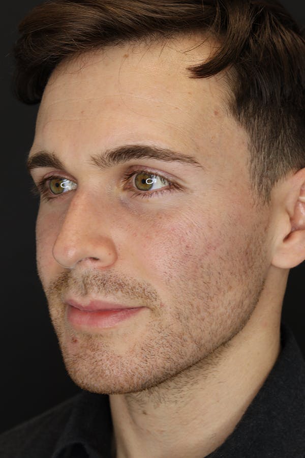 Rhinoplasty Before & After Gallery - Patient 53084383 - Image 3