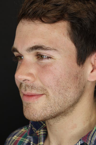 Rhinoplasty Before & After Gallery - Patient 53084383 - Image 4