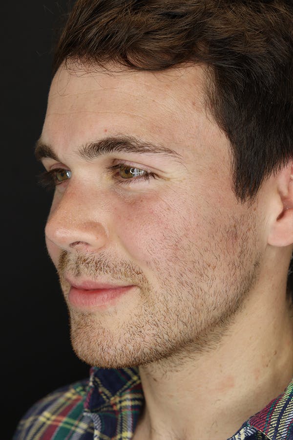 Rhinoplasty Before & After Gallery - Patient 53084383 - Image 4