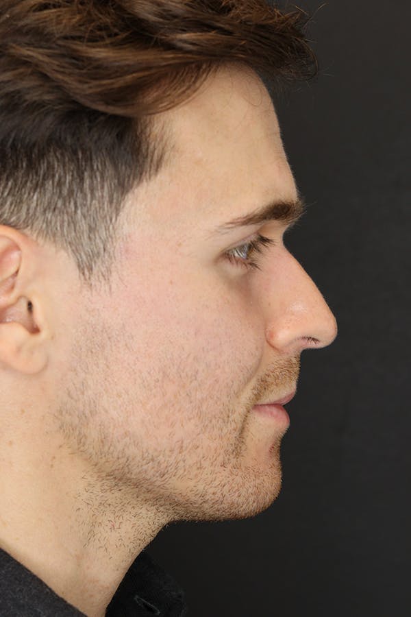 Rhinoplasty Before & After Gallery - Patient 53084383 - Image 5