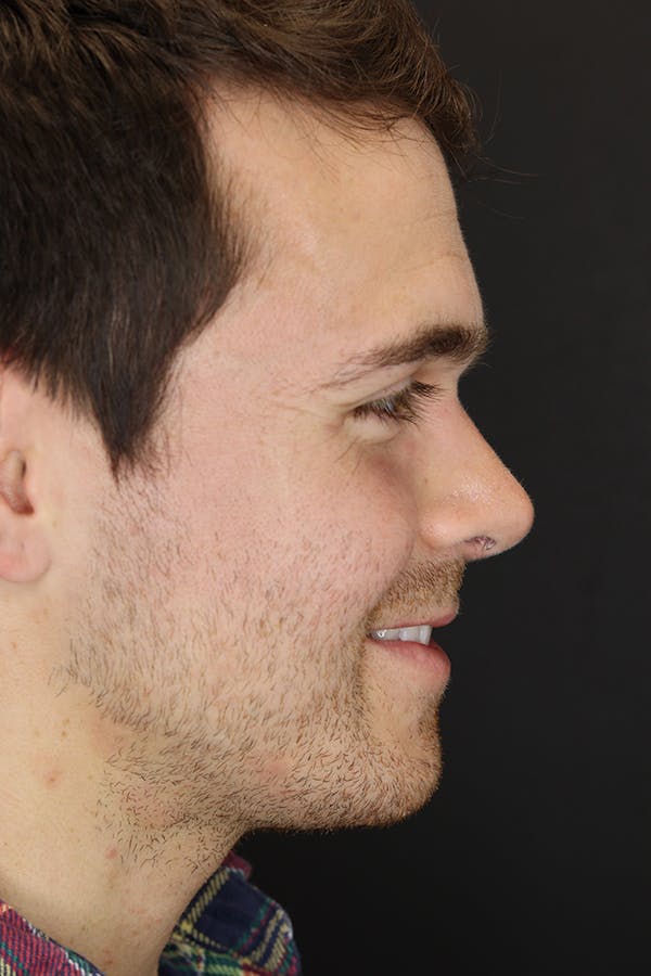 Rhinoplasty Before & After Gallery - Patient 53084383 - Image 6