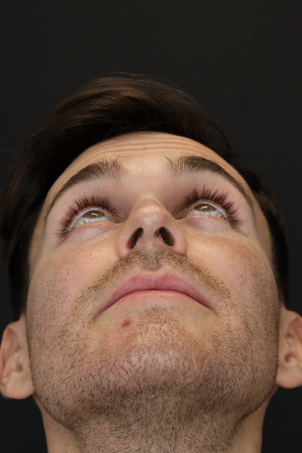Rhinoplasty Before & After Gallery - Patient 53084383 - Image 7