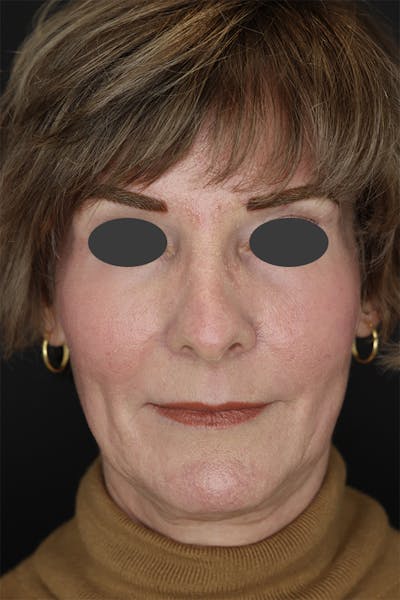 Revision Rhinoplasty Before & After Gallery - Patient 53084202 - Image 1