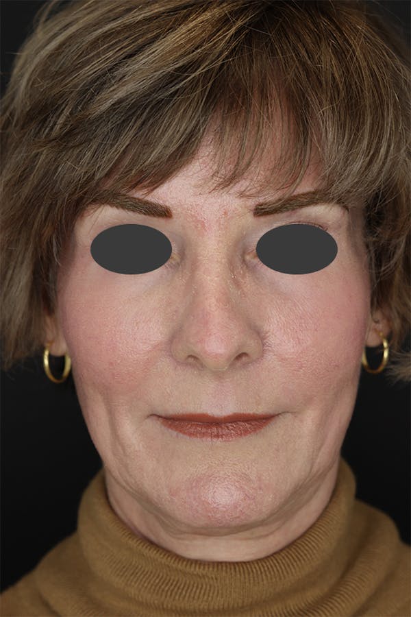 Revision Rhinoplasty Before & After Gallery - Patient 53084202 - Image 1