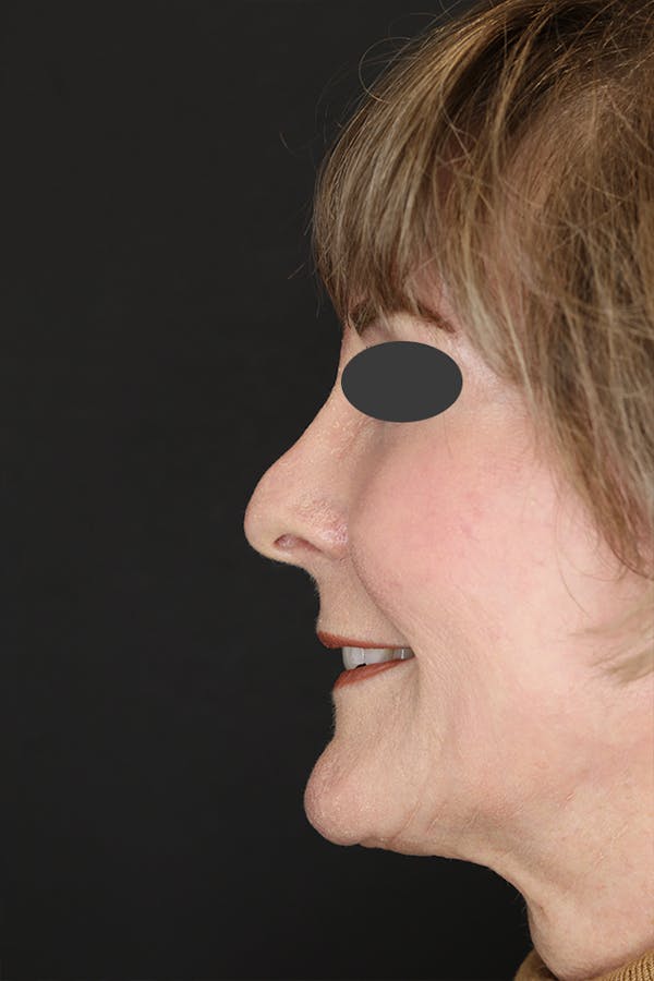 Revision Rhinoplasty Before & After Gallery - Patient 53084202 - Image 3
