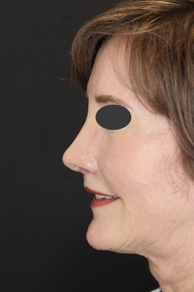 Revision Rhinoplasty Before & After Gallery - Patient 53084202 - Image 4
