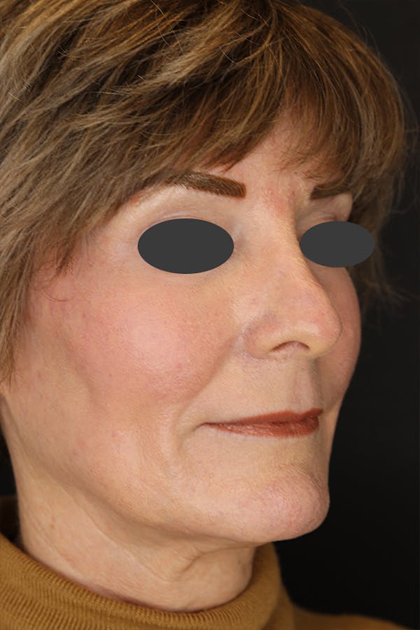 Revision Rhinoplasty Before & After Gallery - Patient 53084202 - Image 5