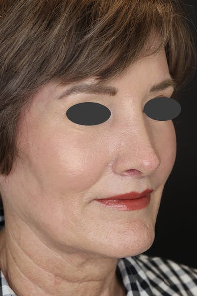 Revision Rhinoplasty Before & After Gallery - Patient 53084202 - Image 6