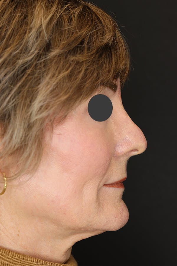 Revision Rhinoplasty Before & After Gallery - Patient 53084202 - Image 7
