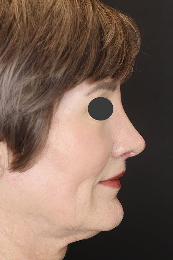 Revision Rhinoplasty Before & After Gallery - Patient 53084202 - Image 8
