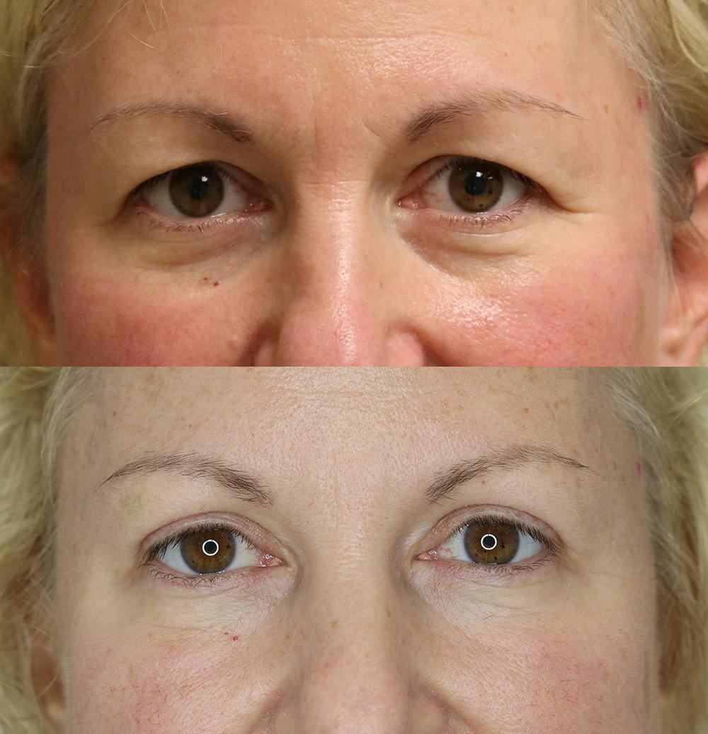 Eyelid Surgery Before & After Gallery - Patient 57007569 - Image 1