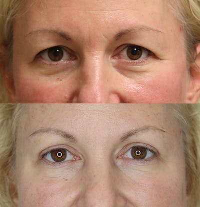 Eyelid Surgery Before & After Gallery - Patient 57007569 - Image 1