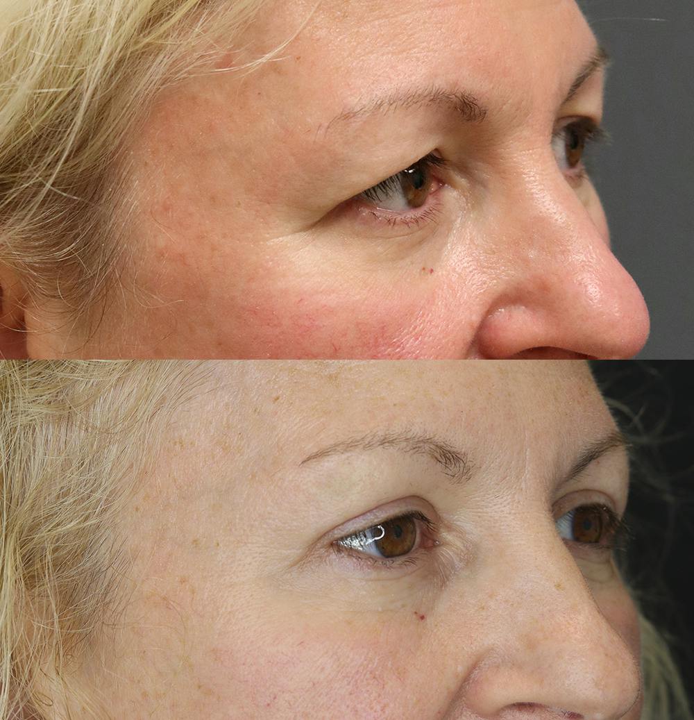 Eyelid Surgery Gallery - Patient 57007569 - Image 2