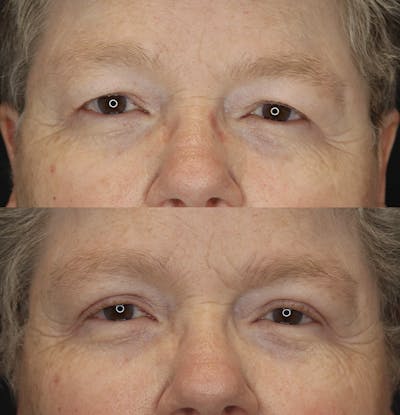 Eyelid Surgery Before & After Gallery - Patient 57007570 - Image 1