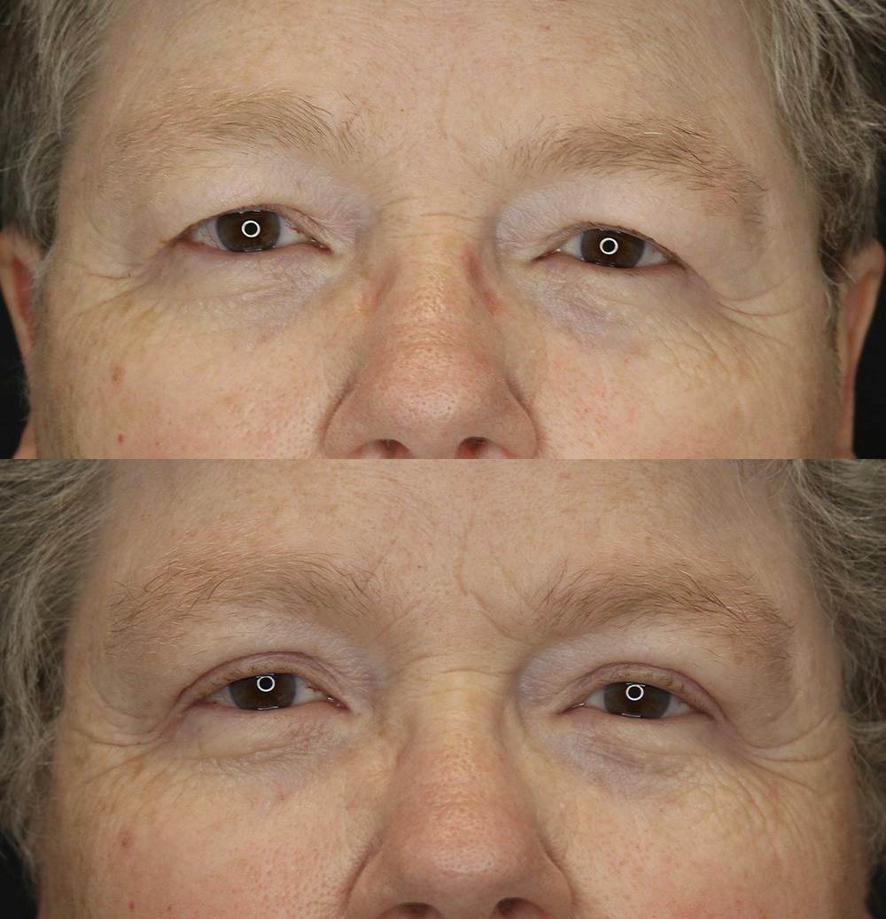 Eyelid Surgery Gallery - Patient 57007570 - Image 1