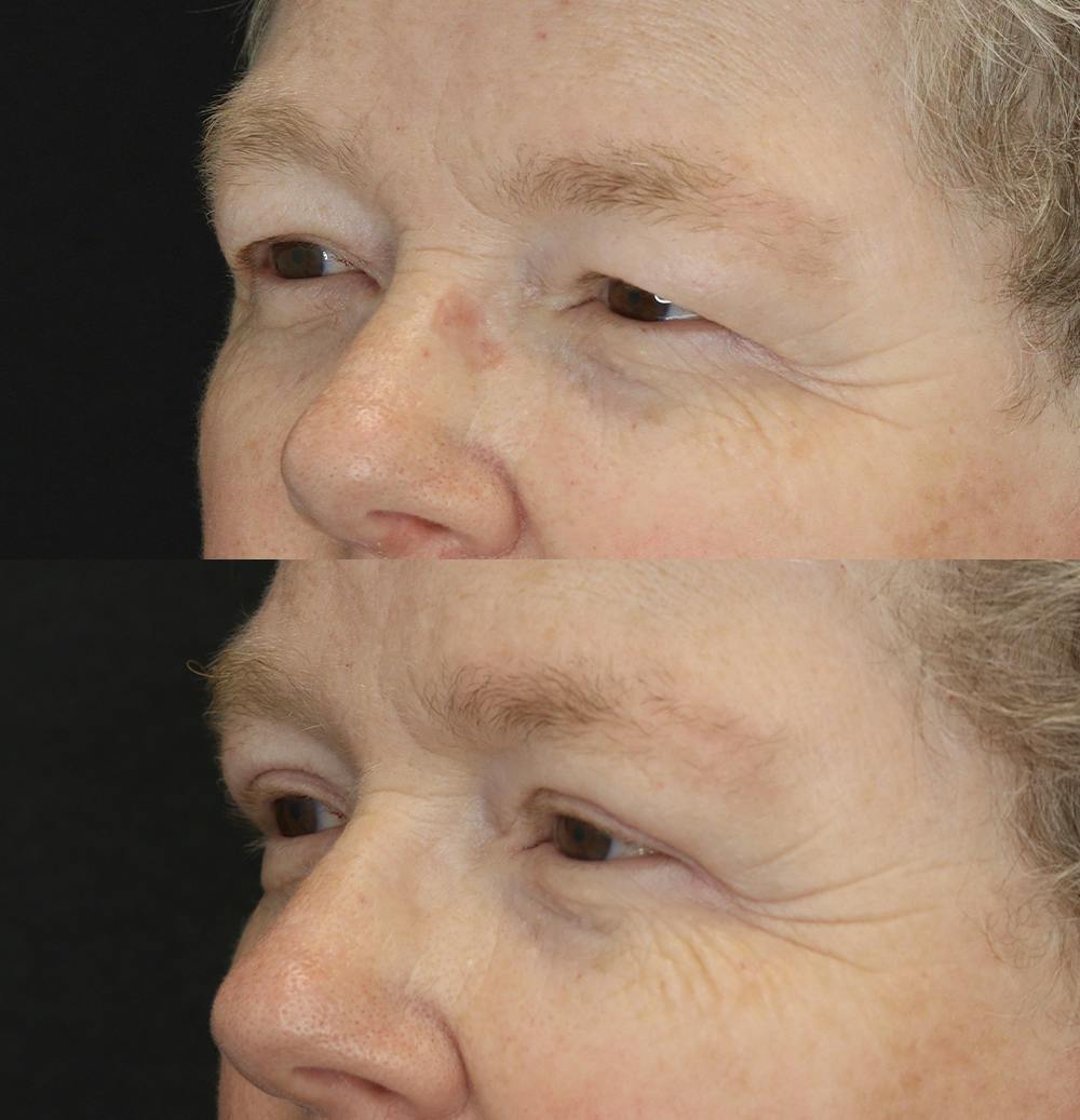 Eyelid Surgery Gallery - Patient 57007570 - Image 2