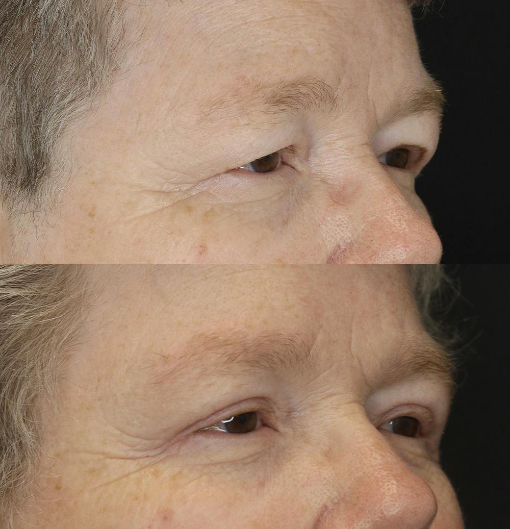 Eyelid Surgery Before & After Gallery - Patient 57007570 - Image 3