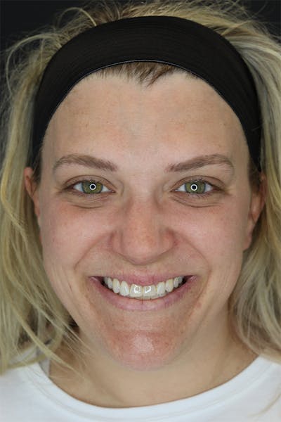 Neck Liposuction Before & After Gallery - Patient 57007672 - Image 1
