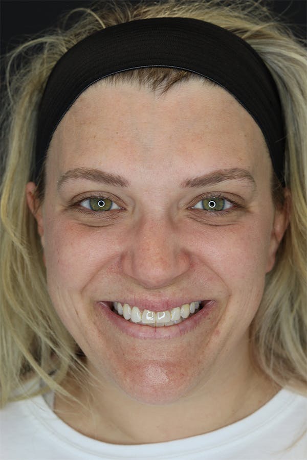Neck Liposuction Before & After Gallery - Patient 57007672 - Image 1