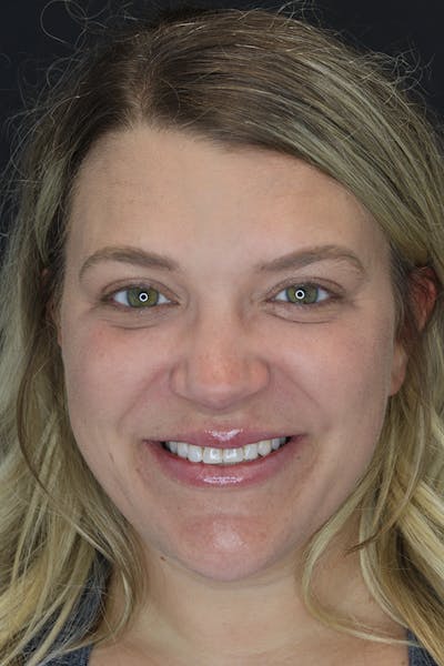 Neck Liposuction Before & After Gallery - Patient 57007672 - Image 2