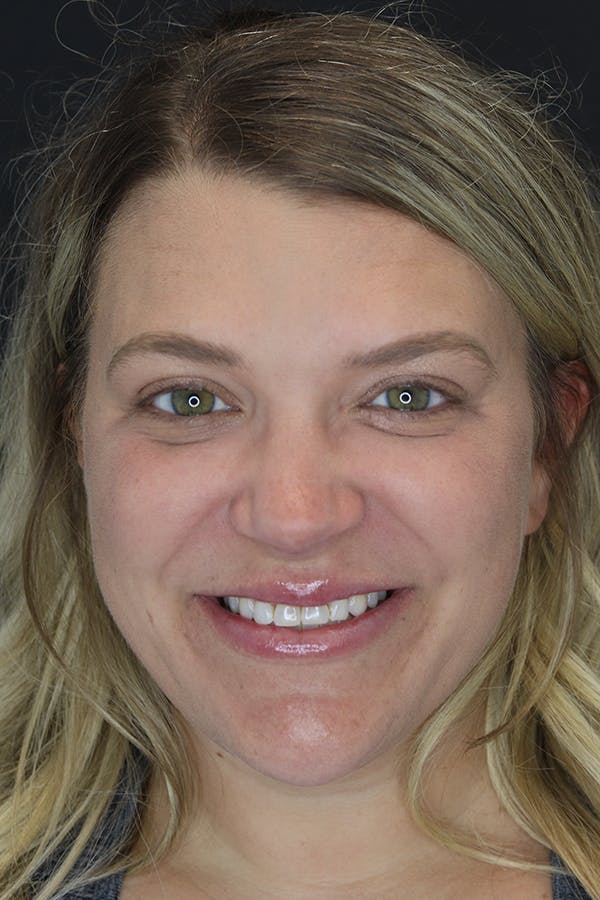 Neck Liposuction Before & After Gallery - Patient 57007672 - Image 2