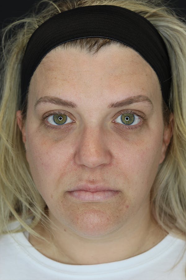 Facial Fillers Before & After Gallery - Patient 57007692 - Image 3