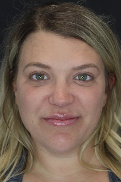 Facial Fillers Before & After Gallery - Patient 57007692 - Image 4