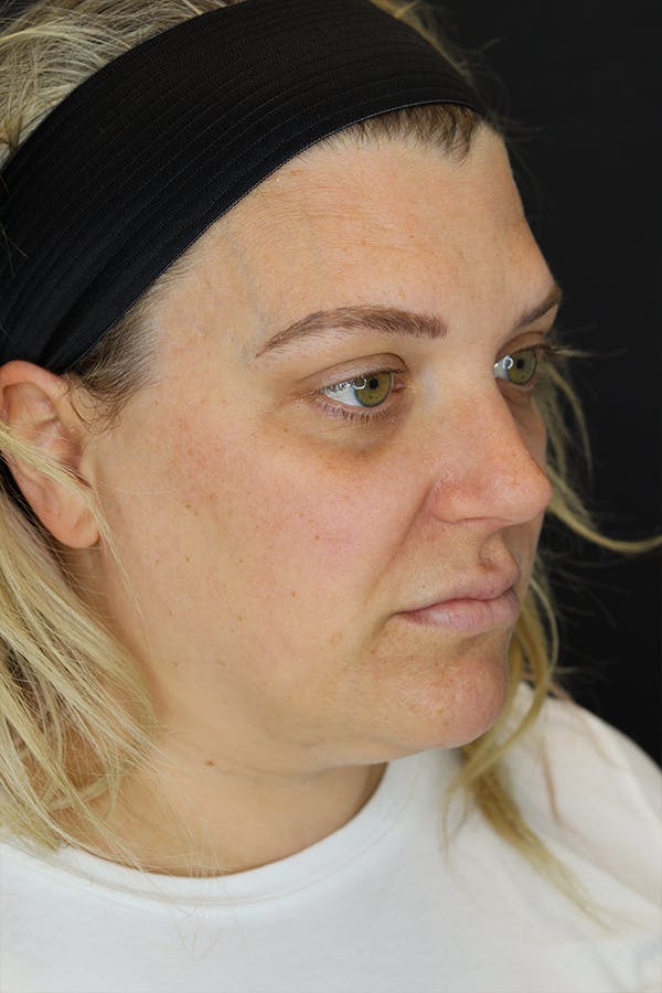 Neck Liposuction Before & After Gallery - Patient 57007672 - Image 5
