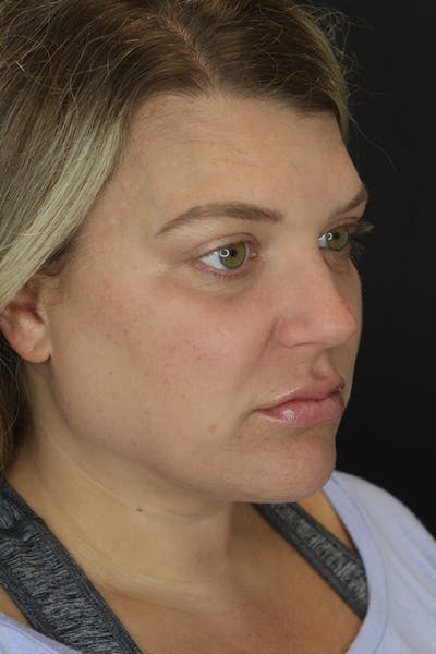 Neck Liposuction Before & After Gallery - Patient 57007672 - Image 6